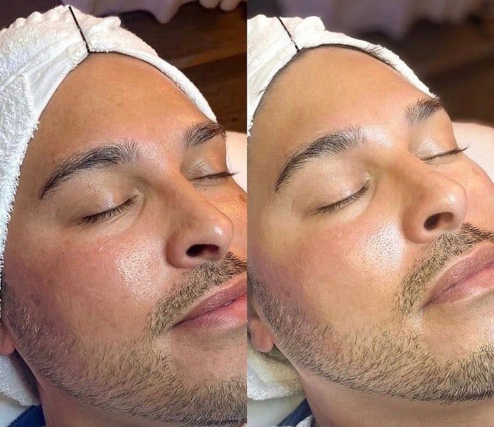 HydraFacial Treatment Ridgeline Aesthetics